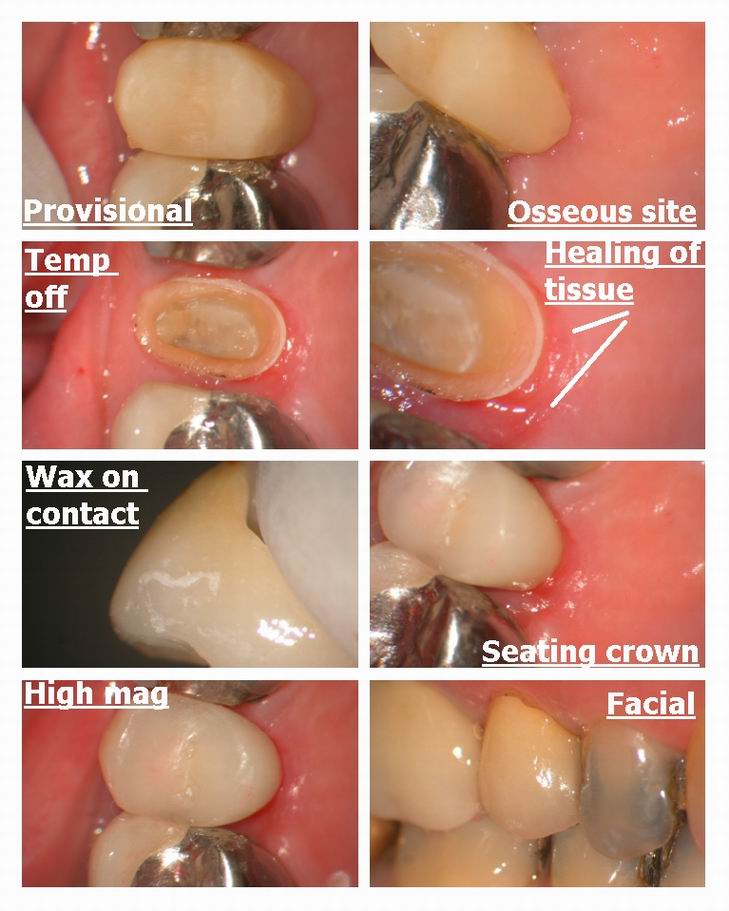 Resize of Crown Insert.jpg